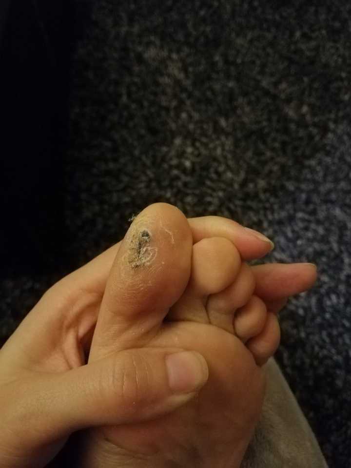 关于门炮疣的深入了解,门炮疣深度解析